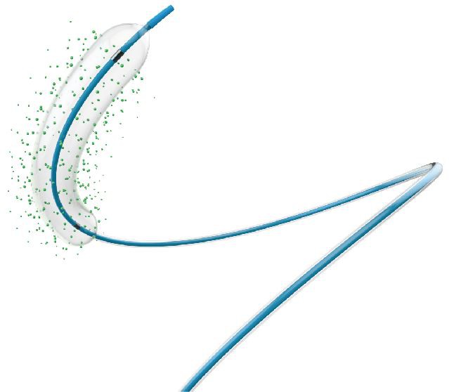 파클리탁셀 약물 코팅 풍선